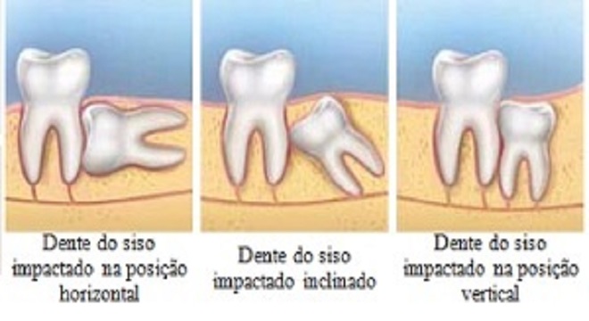 Dente Do Siso Dente Serotino Ou Terceiro Molar Biblioteca Virtual