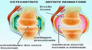 artrita inflamatie articulara)