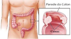 cancerul de colon