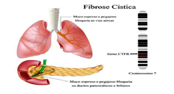 Fibrosis quistica asociacion