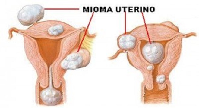 Miomas Uterinos Biblioteca Virtual Em Saúde Ms