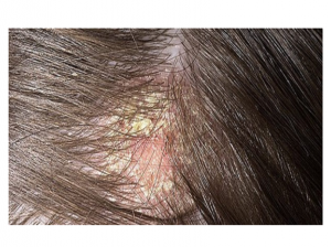 Caspa (dermatite seborreica) | Biblioteca Virtual em Saúde MS