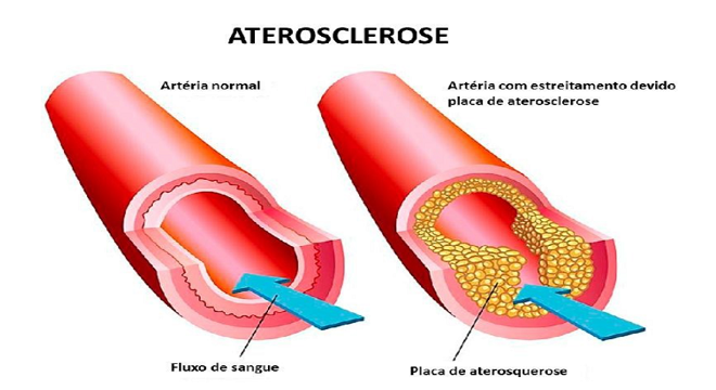 Aterosclerose E Arteriosclerose Biblioteca Virtual Em Saúde Ms 9142