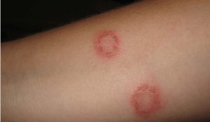 Camaragibe Agora - 🔴 Como identificar e tratar a Impingem A impingem,  conhecida cientificamente como Tinea corporis, é doença de pele causada por  fungos, que provoca o surgimento de pequenas vesículas de