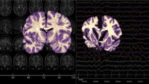 Estudo revela que mais de 50% dos casos de demência na América Latina são evitáveis