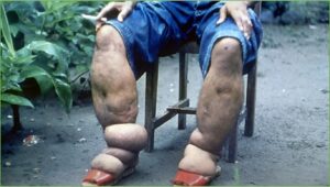 Brasil elimina transmissão da filariose linfática como problema de saúde pública